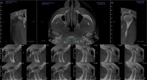 CBCT image